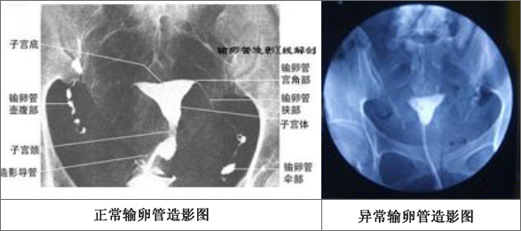 输卵管造影正常对比图片