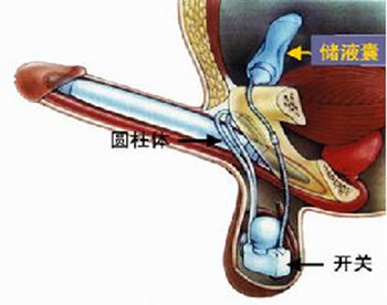 逆行射精